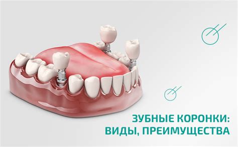 Использование коронки для настройки