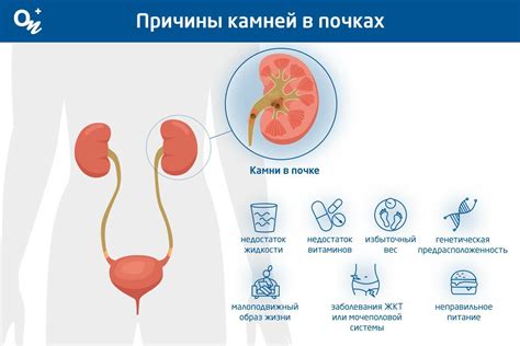 Медикаментозная терапия для лечения камней в почках