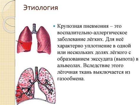 Роль кардиотоников при пневмонии
