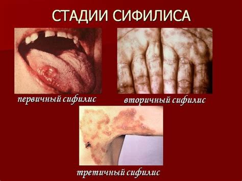 Сифилис