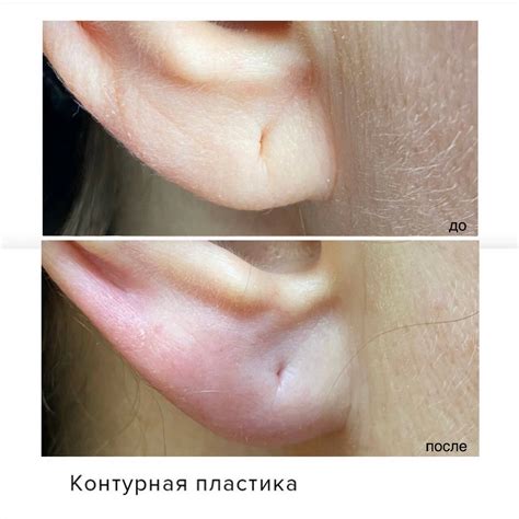 Этническая и генетическая особенность мочек ушей у евреев