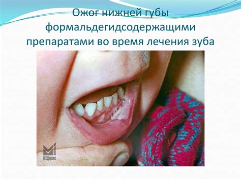 Возможные методы лечения и профилактики хронического воспаления полости рта у детей