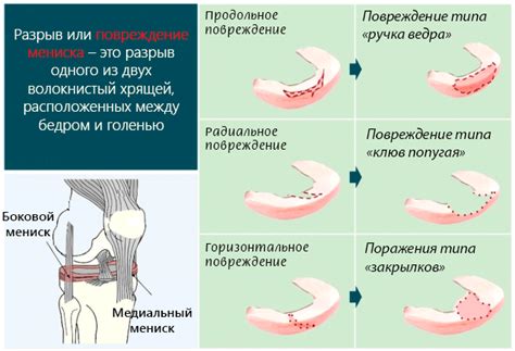 Диагностика дегенеративных изменений менисков: важная часть поиска и понимания проблемы
