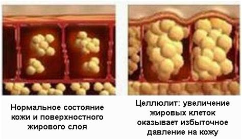 Как победить целлюлит: эффективные способы