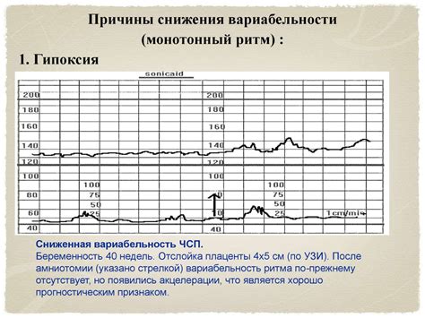 Кардиотокография в качестве метода скрининга нарушений плода