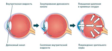 Лечение повышенного глазного давления