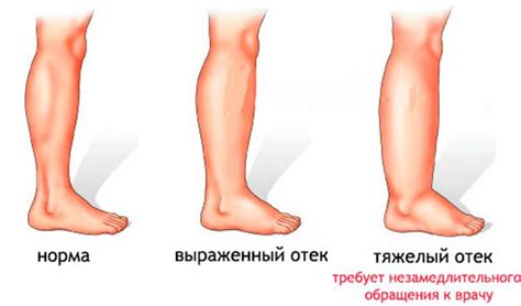 Методы восстановления после отека в области щиколотки