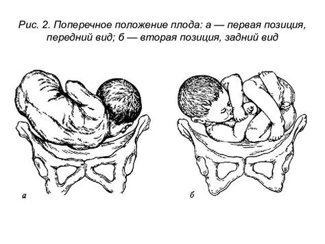 Определение положения плода в продольном предлежании головного

