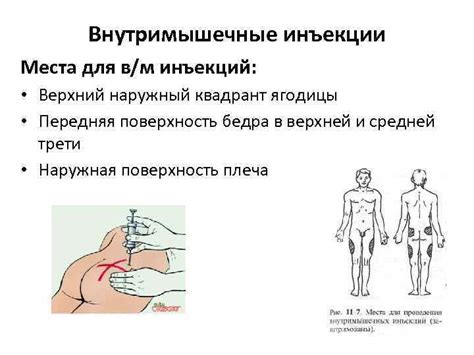 Особенности внутримышечного введения