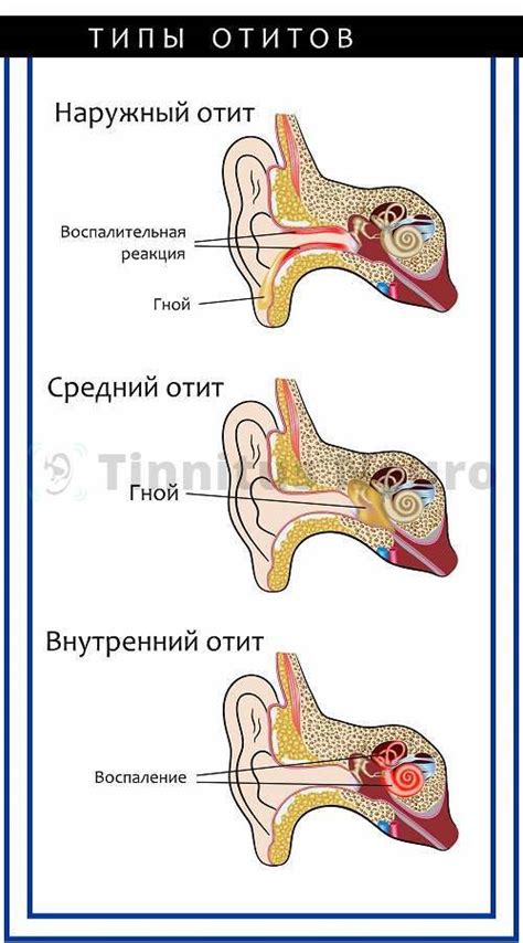 Ощущение заложенности уха с шумом