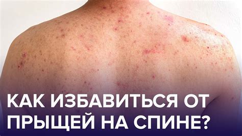 Поводы для образования царапин на спине и техники, которые их вызывают