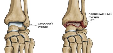 Причины и симптомы отечности в области голеностопного сустава