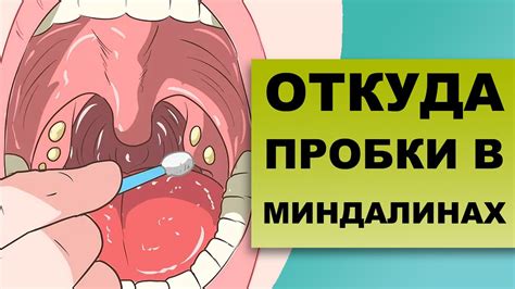 Причины образования гноя