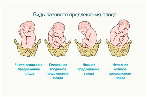 Причины предположения продольного расположения головного плода