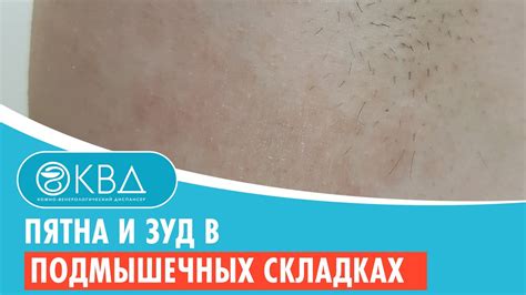 Проблема излишних складок в области подмышечных впадин: причины и последствия