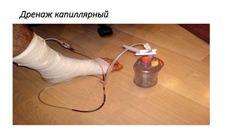 Проведение процедуры дренирования пупка