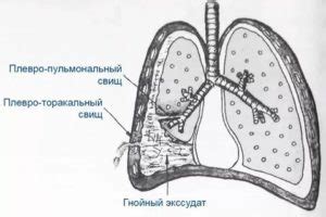 Процесс формирования плевральных спаек и их структура