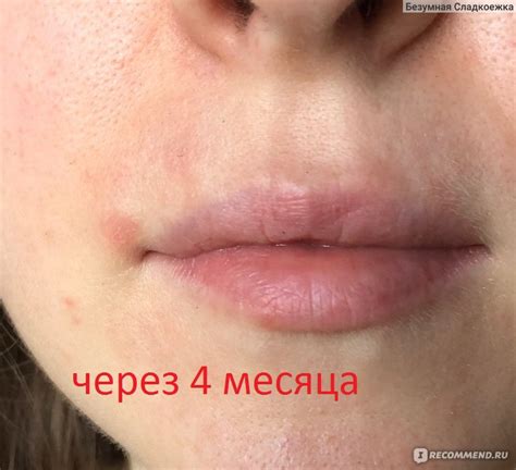 Роль медицины в понимании механизма появления родинок над верхней губой
