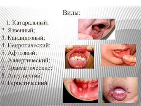 Частота встречаемости постоянного стоматита у детей и возрастные особенности