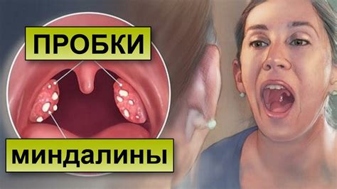 Что такое гнойные шарики на гландах и как они возникают