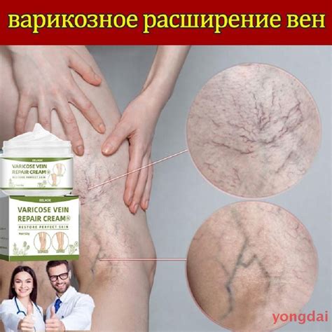 Эффективное устранение отеков и профилактика варикозного расширения вен