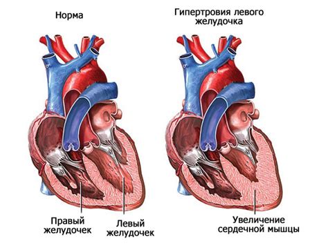 Эффективные методы устранения гипертрофии левого желудочка и их результаты