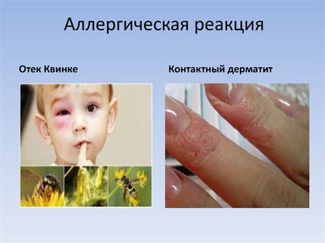 Аллергическая реакция на укус кошки и температура тела