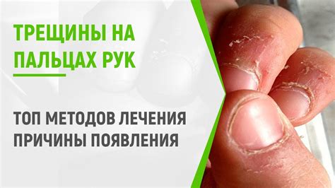 Альтернативные методы лечения трещины в руке