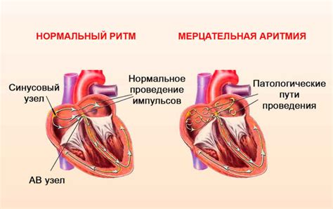 Аритмия: определение и симптомы