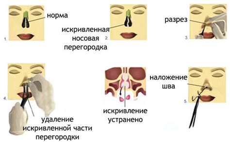 Важность консультации с врачом при подозрении на искривление носовой перегородки