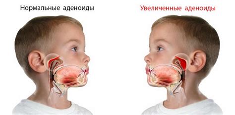 Важность носового аспирации