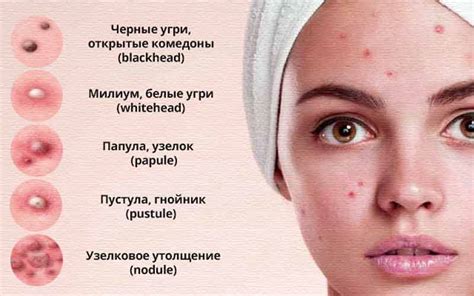Возможность появления прыщей и высыпаний