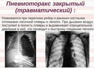 Возможные причины полного срастания грудины