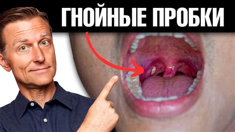 Гной в горле: появление и причины