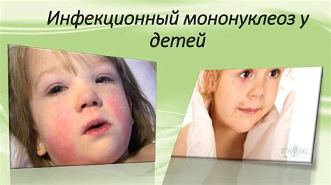 Значение мононуклеоза у детей