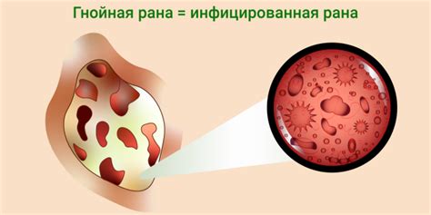 Инфицирование раны