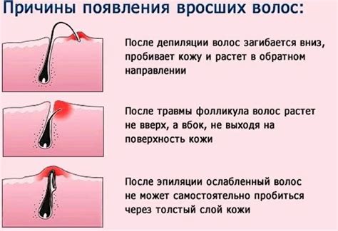 Как исправить вросшие волосы