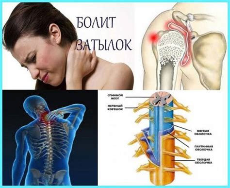 Как определить защемление нерва на спине