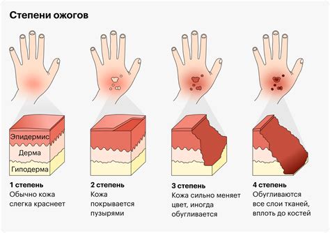 Как снять ожог и симптомы