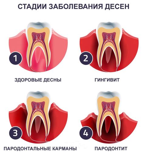 Кровотечение из десен