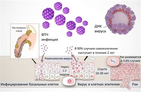 Лечение ВПЧ 16: эффективные методы борьбы с вирусом