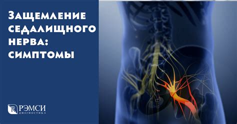 Лечение защемления нерва на спине
