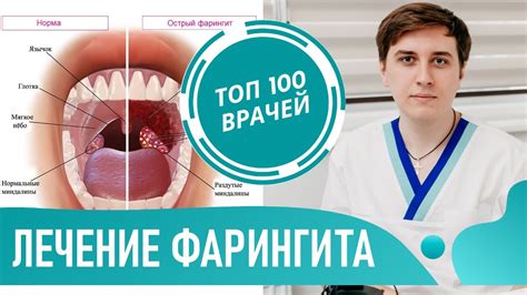 Лечение у горла: