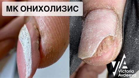 Маникюр при экземе: можно ли делать