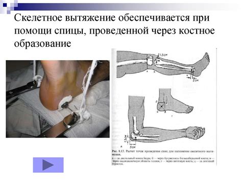 Нетипичные проблемы при лечении переломов