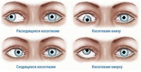 Определение двоения в глазах: симптомы и проверка