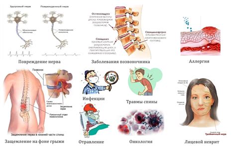 Основные причины тошноты при невралгии