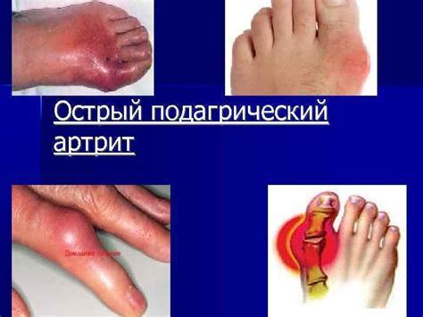 Подагра: симптомы и причины