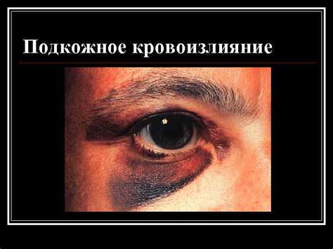 Подкожное кровоизлияние