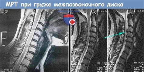 Понятие о грыже шейного отдела позвоночника и его симптомах